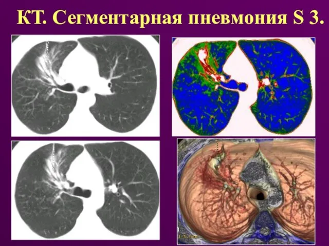 КТ. Сегментарная пневмония S 3.