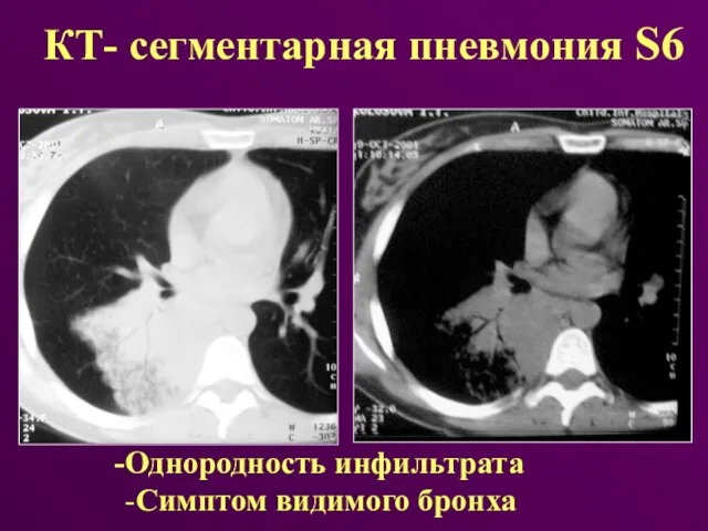 КТ- сегментарная пневмония S6 Однородность инфильтрата -Симптом видимого бронха