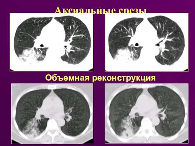 Аксиальные срезы Объемная реконструкция