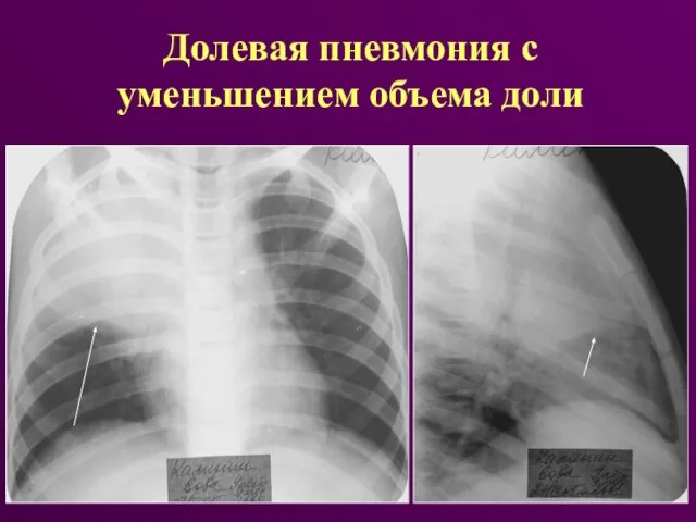 Долевая пневмония с уменьшением объема доли