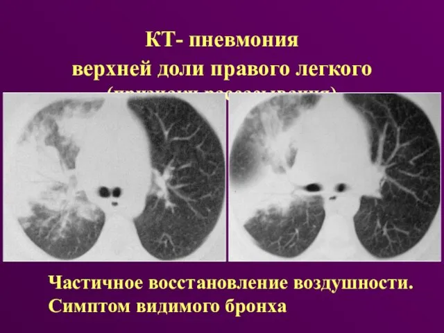 КТ- пневмония верхней доли правого легкого (признаки рассасывания) Частичное восстановление воздушности. Симптом видимого бронха