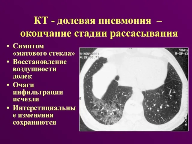 КТ - долевая пневмония – окончание стадии рассасывания Симптом «матового стекла»