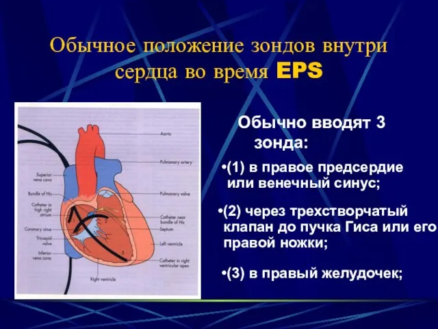 Обычное положение зондов внутри сердца во время EPS Обычно вводят 3