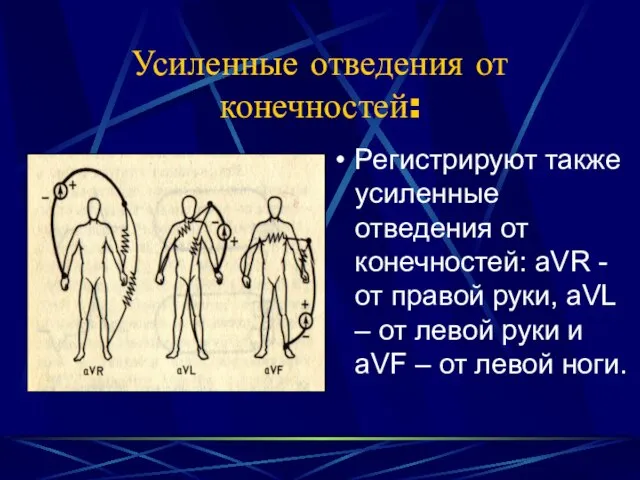 Усиленные отведения от конечностей: Регистрируют также усиленные отведения от конечностей: aVR