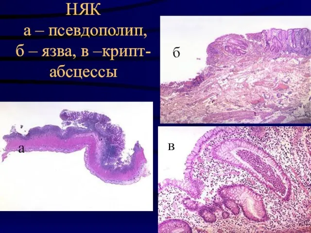 НЯК а – псевдополип, б – язва, в –крипт-абсцессы а б в