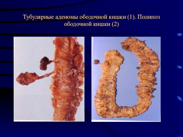 Тубулярные аденомы ободочной кишки (1). Полипоз ободочной кишки (2)