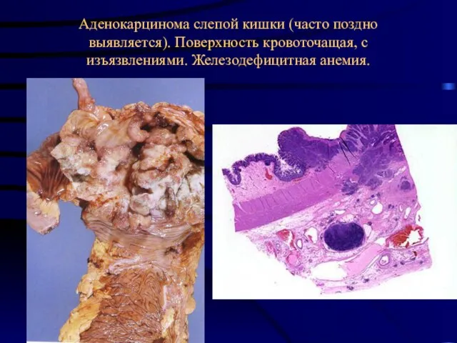 Аденокарцинома слепой кишки (часто поздно выявляется). Поверхность кровоточащая, с изъязвлениями. Железодефицитная анемия.