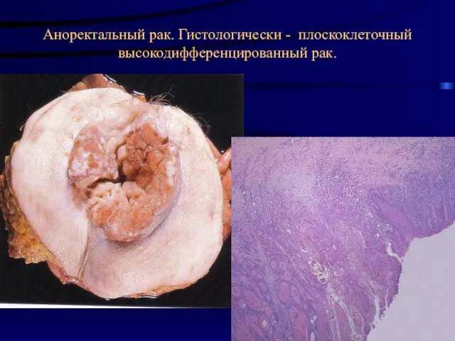 Аноректальный рак. Гистологически - плоскоклеточный высокодифференцированный рак.