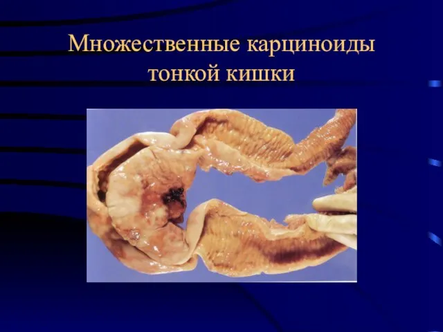 Множественные карциноиды тонкой кишки