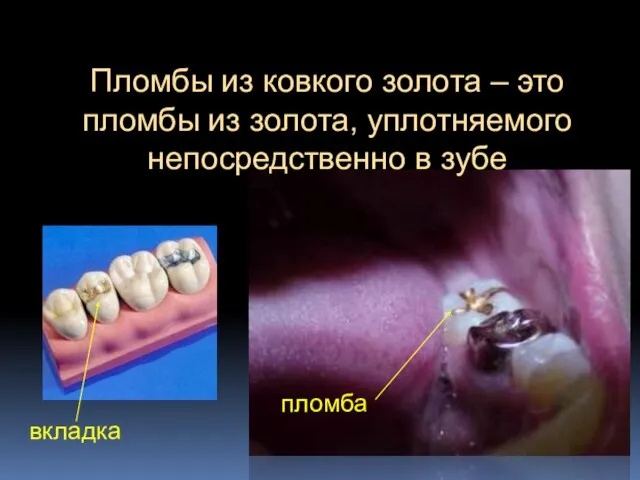 Пломбы из ковкого золота – это пломбы из золота, уплотняемого непосредственно в зубе вкладка пломба