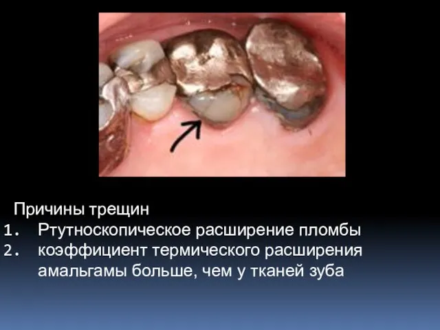 Причины трещин Ртутноскопическое расширение пломбы коэффициент термического расширения амальгамы больше, чем у тканей зуба
