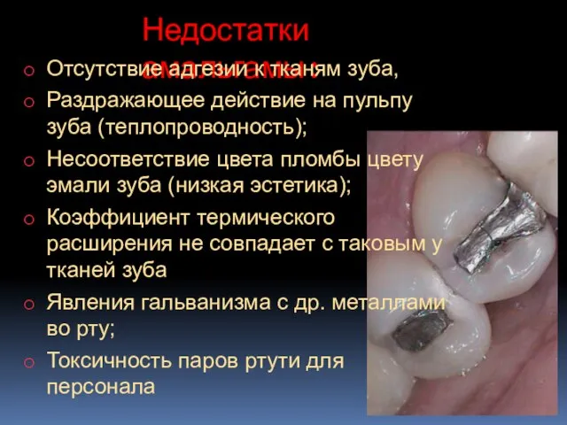 Недостатки амальгамы: Отсутствие адгезии к тканям зуба, Раздражающее действие на пульпу