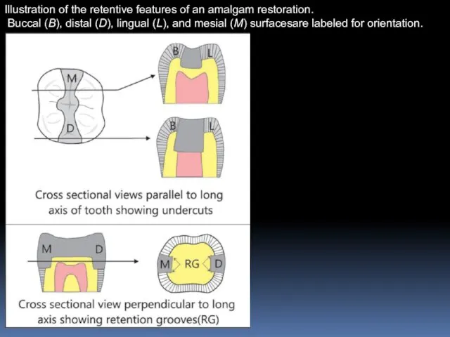 Illustration of the retentive features of an amalgam restoration. Buccal (B),