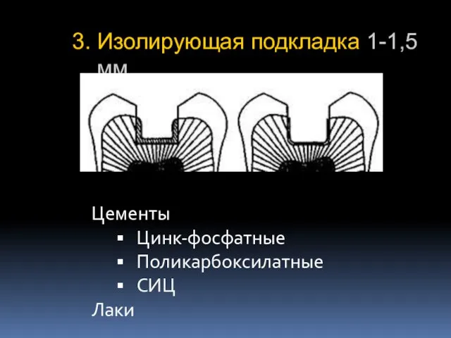 3. Изолирующая подкладка 1-1,5 мм. Цементы Цинк-фосфатные Поликарбоксилатные СИЦ Лаки