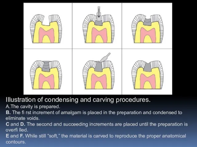 Illustration of condensing and carving procedures. А.The cavity is prepared. B.