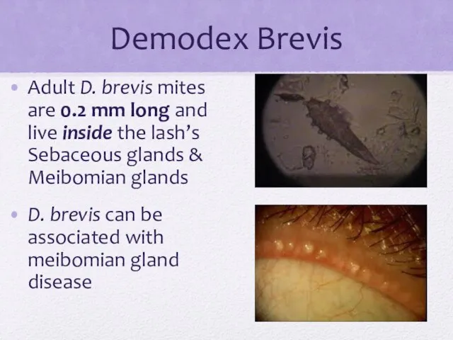 Demodex Brevis Adult D. brevis mites are 0.2 mm long and