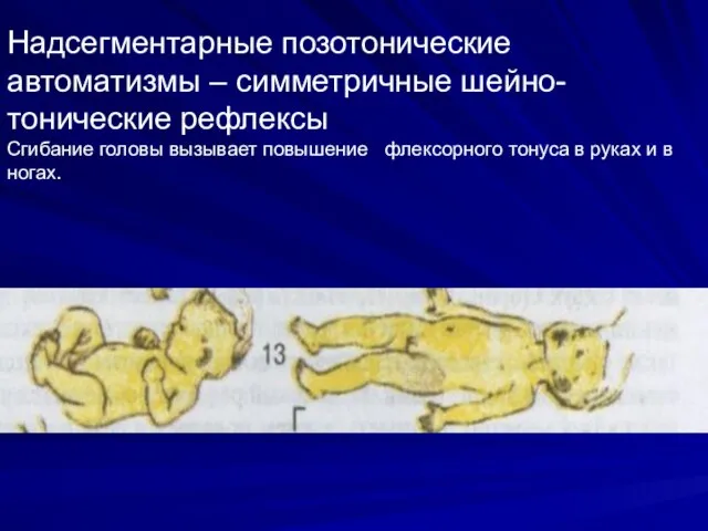 Надсегментарные позотонические автоматизмы – симметричные шейно-тонические рефлексы Сгибание головы вызывает повышение