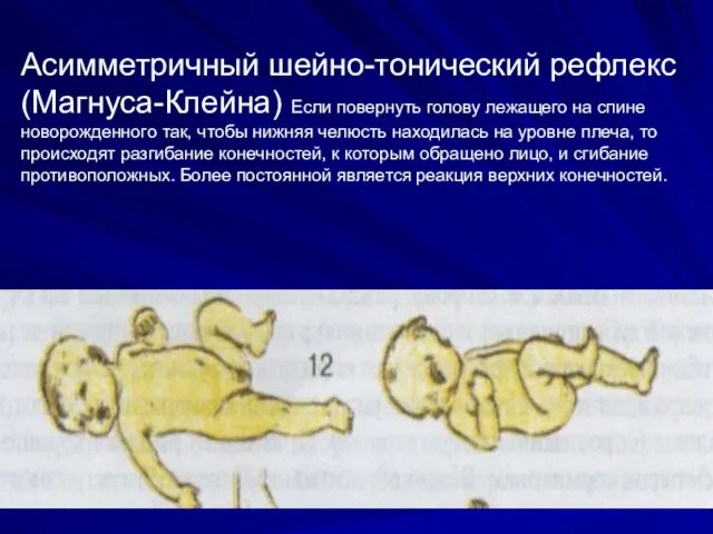 Асимметричный шейно-тонический рефлекс (Магнуса-Клейна) Если повернуть голову лежащего на спине новорожденного