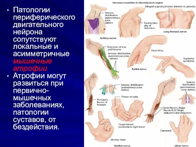 Патологии периферического двигательного нейрона сопутствуют локальные и асимметричные мышечные атрофии Атрофии