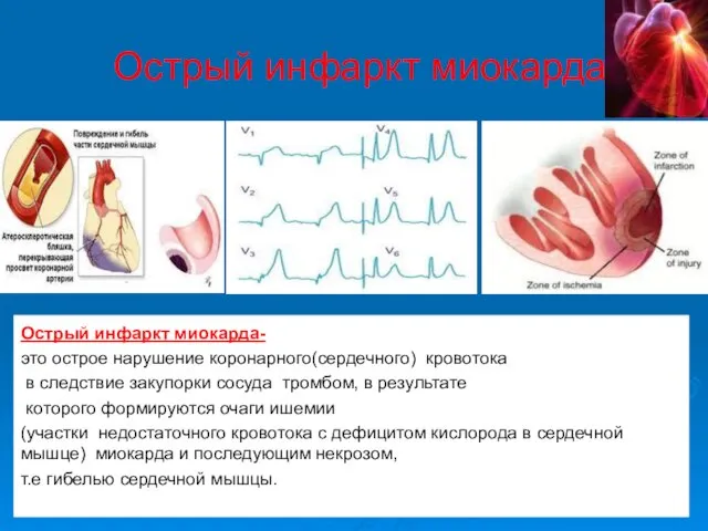 Острый инфаркт миокарда Острый инфаркт миокарда- это острое нарушение коронарного(сердечного) кровотока