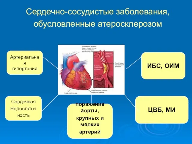 Сердечно-сосудистые заболевания, обусловленные атеросклерозом Артериальная гипертония Сердечная Недостаточ ность поражение аорты,