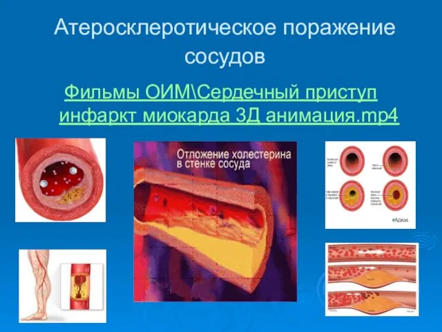 Атеросклеротическое поражение сосудов Фильмы ОИМ\Сердечный приступ инфаркт миокарда 3Д анимация.mp4