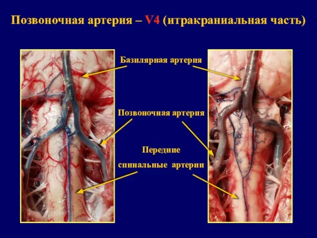 Позвоночная артерия – V4 (итракраниальная часть) Позвоночная артерия Передние спинальные артерии Базилярная артерия