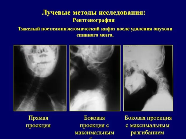 Лучевые методы исследования: Рентгенография Прямая проекция Боковая проекция с максимальным сгибанием