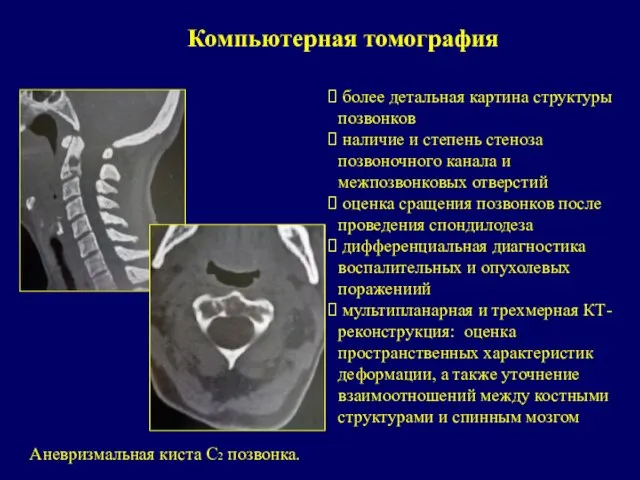 Компьютерная томография более детальная картина структуры позвонков наличие и степень стеноза