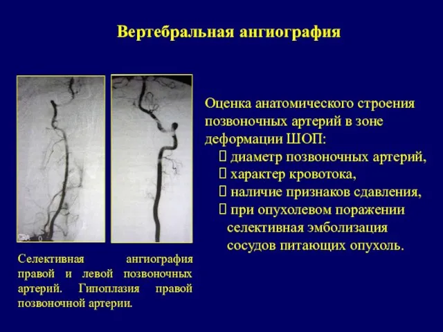 Вертебральная ангиография Оценка анатомического строения позвоночных артерий в зоне деформации ШОП: