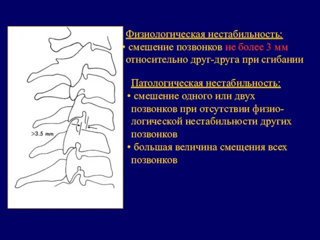 Физиологическая нестабильность: смешение позвонков не более 3 мм относительно друг-друга при