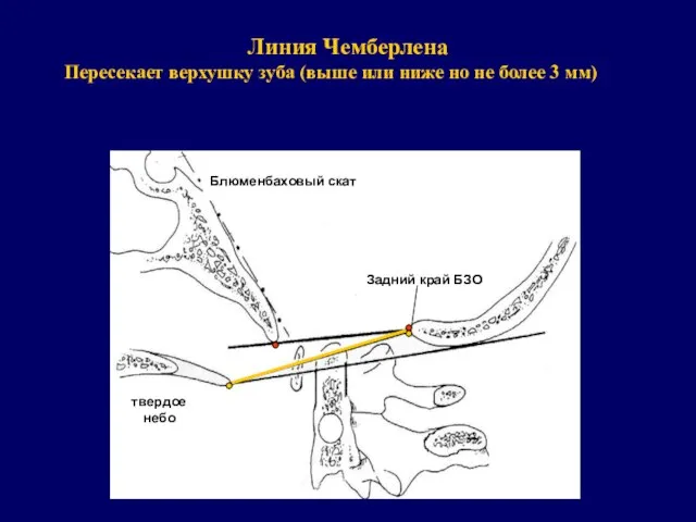 Линия Чемберлена Пересекает верхушку зуба (выше или ниже но не более 3 мм)