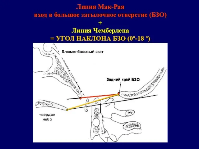 Линия Мак-Рая вход в большое затылочное отверстие (БЗО) + Линия Чемберлена