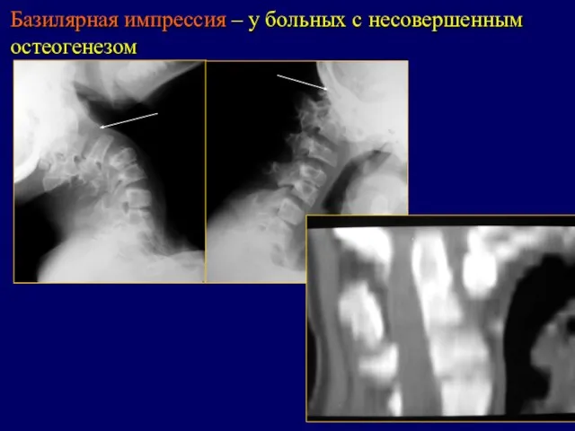 Базилярная импрессия – у больных с несовершенным остеогенезом