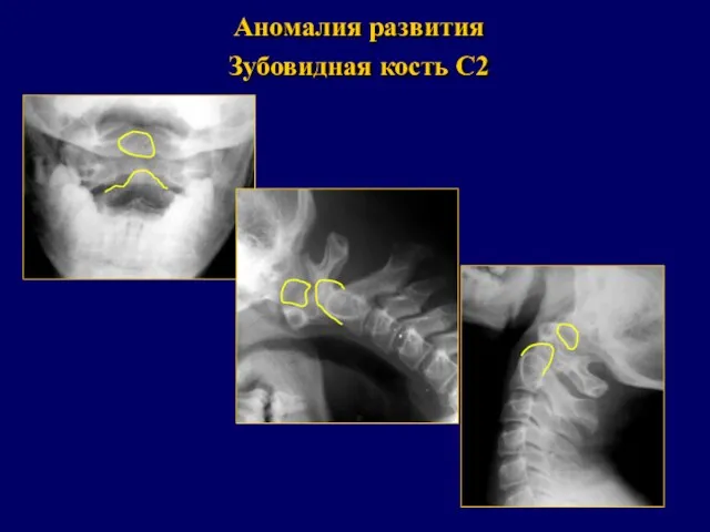 Аномалия развития Зубовидная кость С2