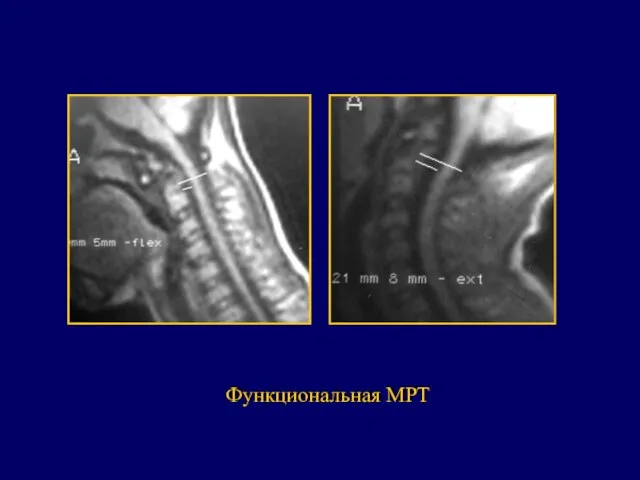 Функциональная МРТ