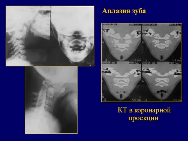 КТ в коронарной проекции Аплазия зуба