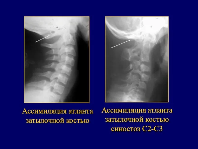 Ассимиляция атланта затылочной костью синостоз С2-С3 Ассимиляция атланта затылочной костью