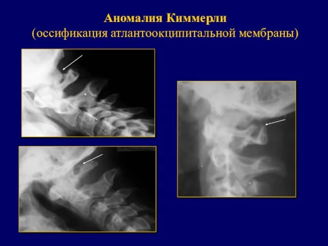 Аномалия Киммерли (оссификация атлантоокципитальной мембраны)