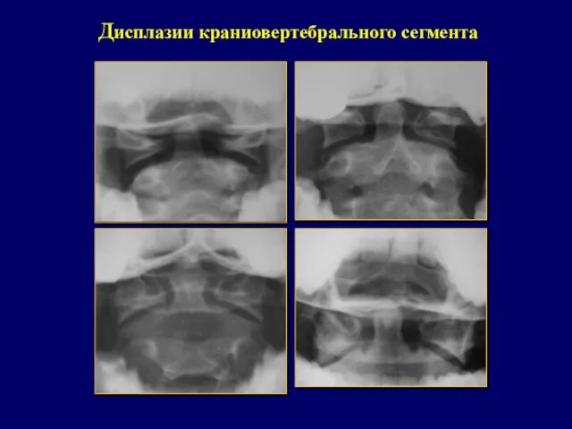 Дисплазии краниовертебрального сегмента