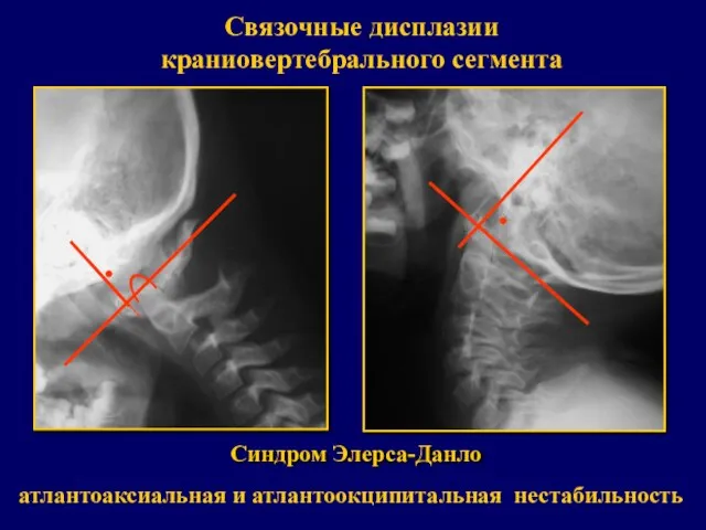 Синдром Элерса-Данло Связочные дисплазии краниовертебрального сегмента атлантоаксиальная и атлантоокципитальная нестабильность