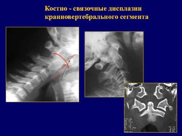 Костно - связочные дисплазии краниовертебрального сегмента