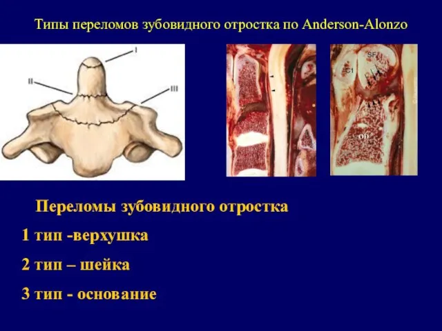Переломы зубовидного отростка 1 тип -верхушка 2 тип – шейка 3