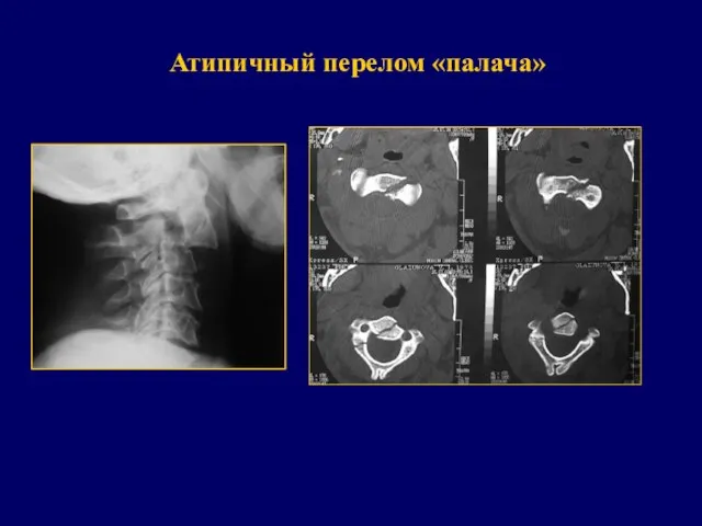 Атипичный перелом «палача»