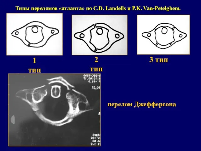 Типы переломов «атланта» по C.D. Landells и P.K. Van-Petelghem. 1 тип