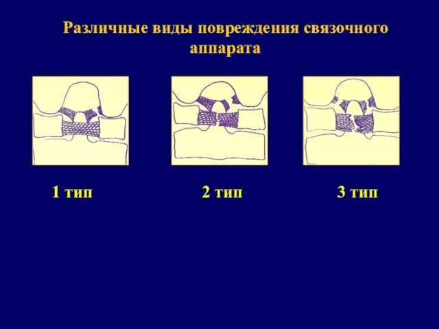 1 тип 2 тип 3 тип Различные виды повреждения связочного аппарата