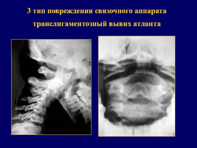 3 тип повреждения связочного аппарата транслигаментозный вывих атланта