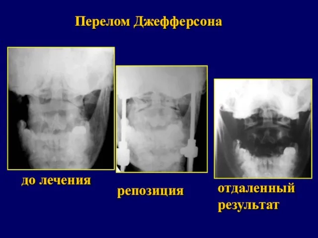 Перелом Джефферсона до лечения репозиция отдаленный результат