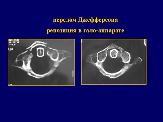 перелом Джефферсона репозиция в гало-аппарате