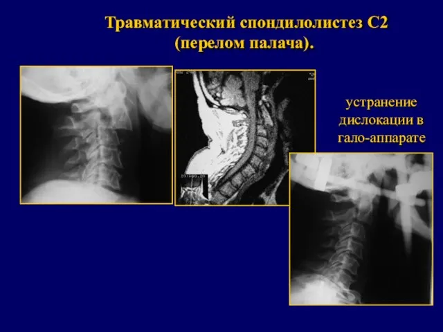 Травматический спондилолистез С2 (перелом палача). устранение дислокации в гало-аппарате